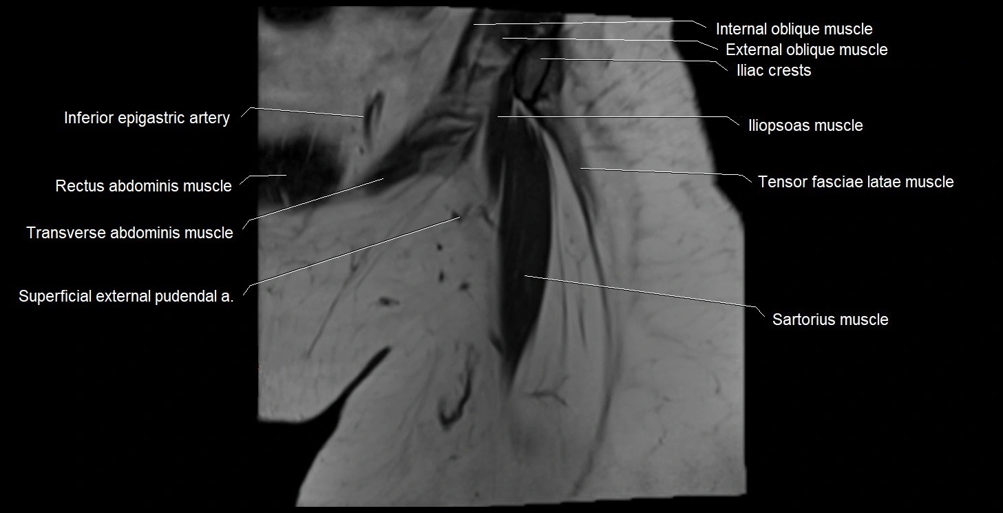 MRI Hip 3T coronal cross sectional anatomy image 1.webp